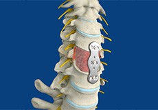 Anterior Cervical Corpectomy and Fusion