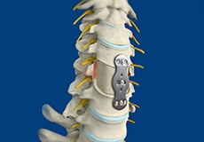 Anterior Lumbar Corpectomy and Fusion