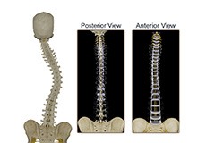 Anterior and Posterior Scoliosis Surgery
