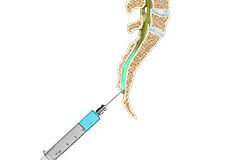 Caudal Epidural Injection