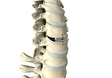 Cervical Arthroplasty