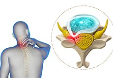 Cervical Decompression