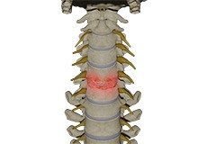 Cervical Degenerative Disorder