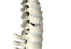 Cervical Disc Replacement