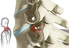 Cervical Foraminotomy