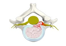 Cervical Herniated Disc