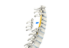 Cervical Laminectomy