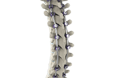 Complex Spinal Reconstruction