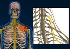 Compression of Thoracic Nerve