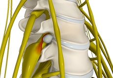 Disc Herniation