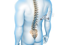 Endoscopic Spine Surgery