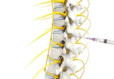 Epidural Spinal Injection