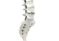 Lumbar Artificial Disc Replacement