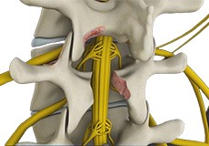 Lumbar Decompression