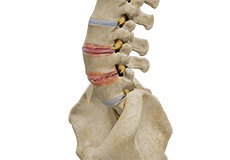 Lumbar Degenerative Disc Disease