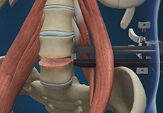 Lumbar Discectomy