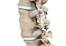 Lumbar Fusion