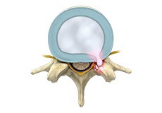 Lumbar Herniated Disc