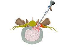 Lumbar Microdiscectomy