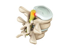 Lumbar Radiculopathy