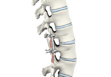 Lumbar Spinal Fusion