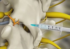 Medial Branch Block Injections