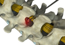 Microdiscectomy