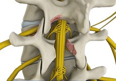 Minimally Invasive Lumbar Discectomy