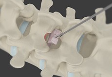 Minimally Invasive Lumbar Decompression