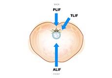 Minimally Invasive Lumbar Fusion