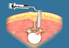 Minimally Invasive Lumbar Surgery