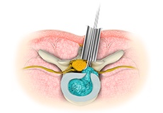 Minimally Invasive Spine Surgery