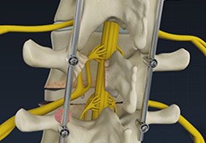 Minimally Invasive TLIF