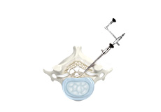 Posterior Cervical Microforaminotomy/Discectomy