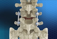 Posterior Lumbar Interbody Fusion (PLIF)