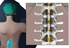 Posterior Thoracic Fusion