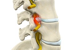 Radiculopathy