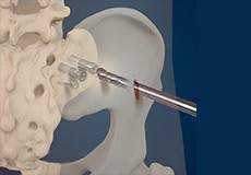 Sacroiliac Joint Minimally Invasive Fusion