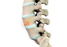 Spinal Compression Fractures