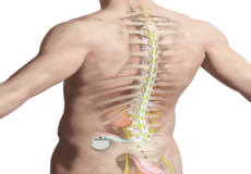 Spinal Cord Stimulator