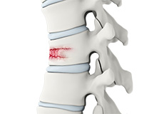 Spinal Fractures