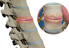 Spinal Infection Decompression