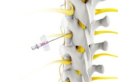 Spine Injections