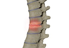 Spondylodiscitis