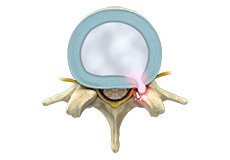 Thoracic Disc Herniation