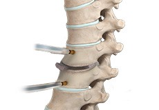 Thoracic Discectomy