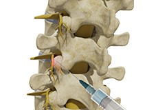 Thoracic Facet Joint Injection