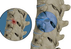 Thoracic Facetectomy