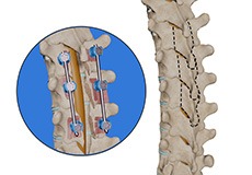 Thoracic Laminectomy