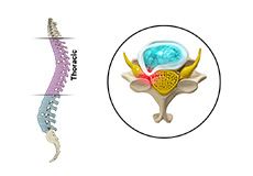 Thoracic Myelopathy